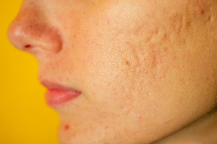 5 Ways to Reduce Acne Scarring